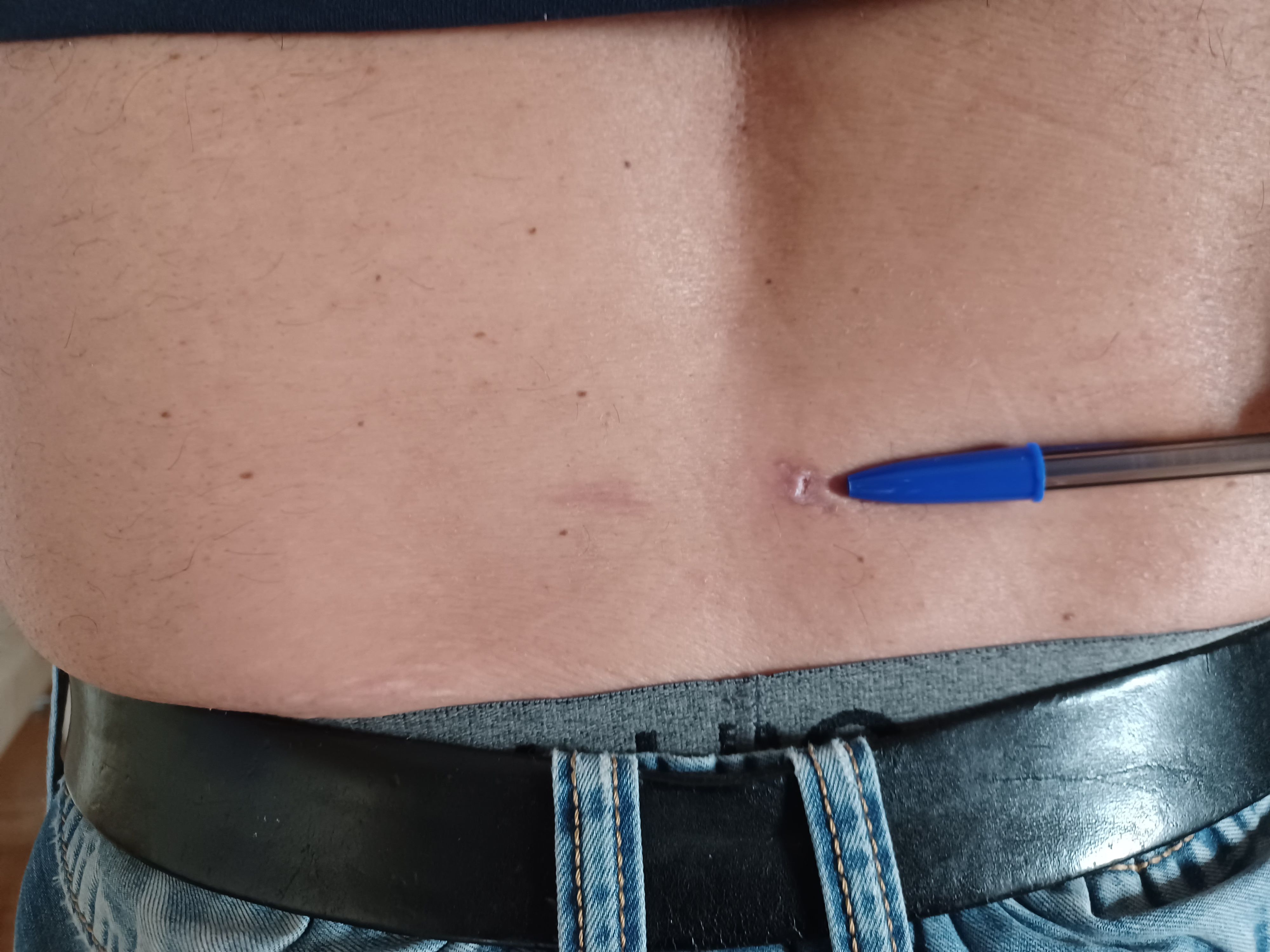 ενδοσκοπική δισκεκτομή4.jpg