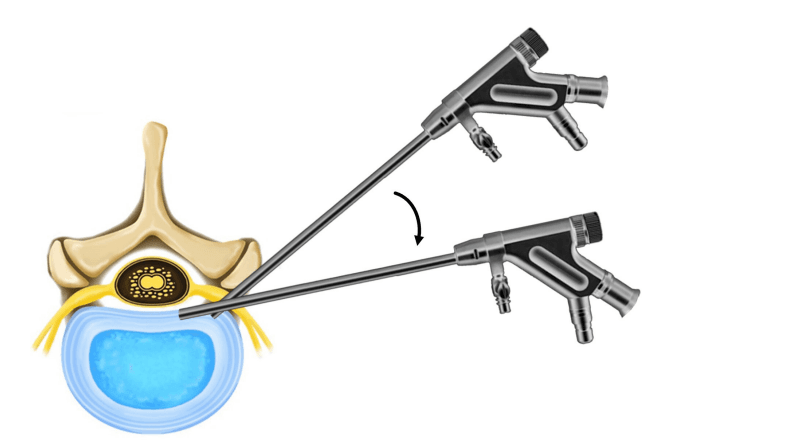 ενδοσκοπική δισκεκτομή.png