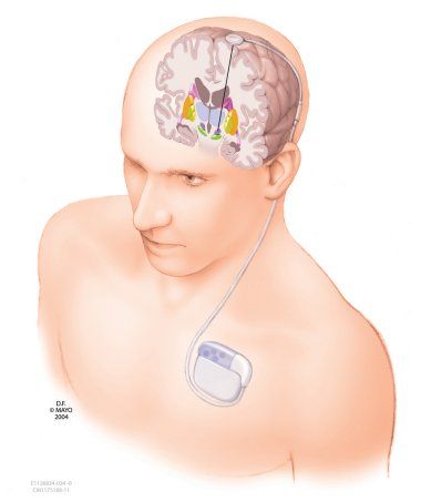 νόσος Πάρκινσον (1).jpg