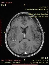 όγκος εγκεφάλου 1 μετα χειρουργειου (8).jpg