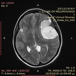 όγκος εγκεφάλου 1 προ χειρουργειου (10).jpg