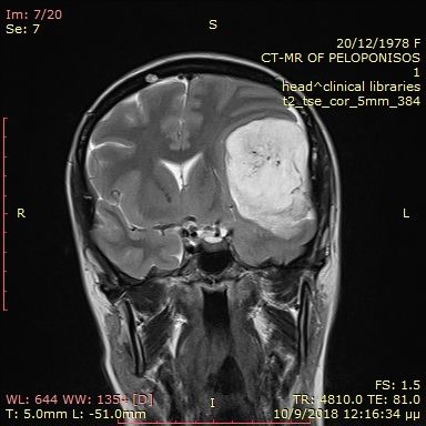 όγκος εγκεφάλου 1 προ χειρουργειου (11).jpg