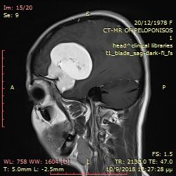 όγκος εγκεφάλου 1 προ χειρουργειου (12).jpg