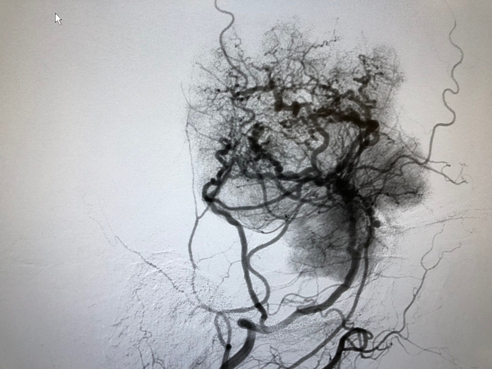 όγκος εγκεφάλου 1 προ χειρουργειου (8).jpg