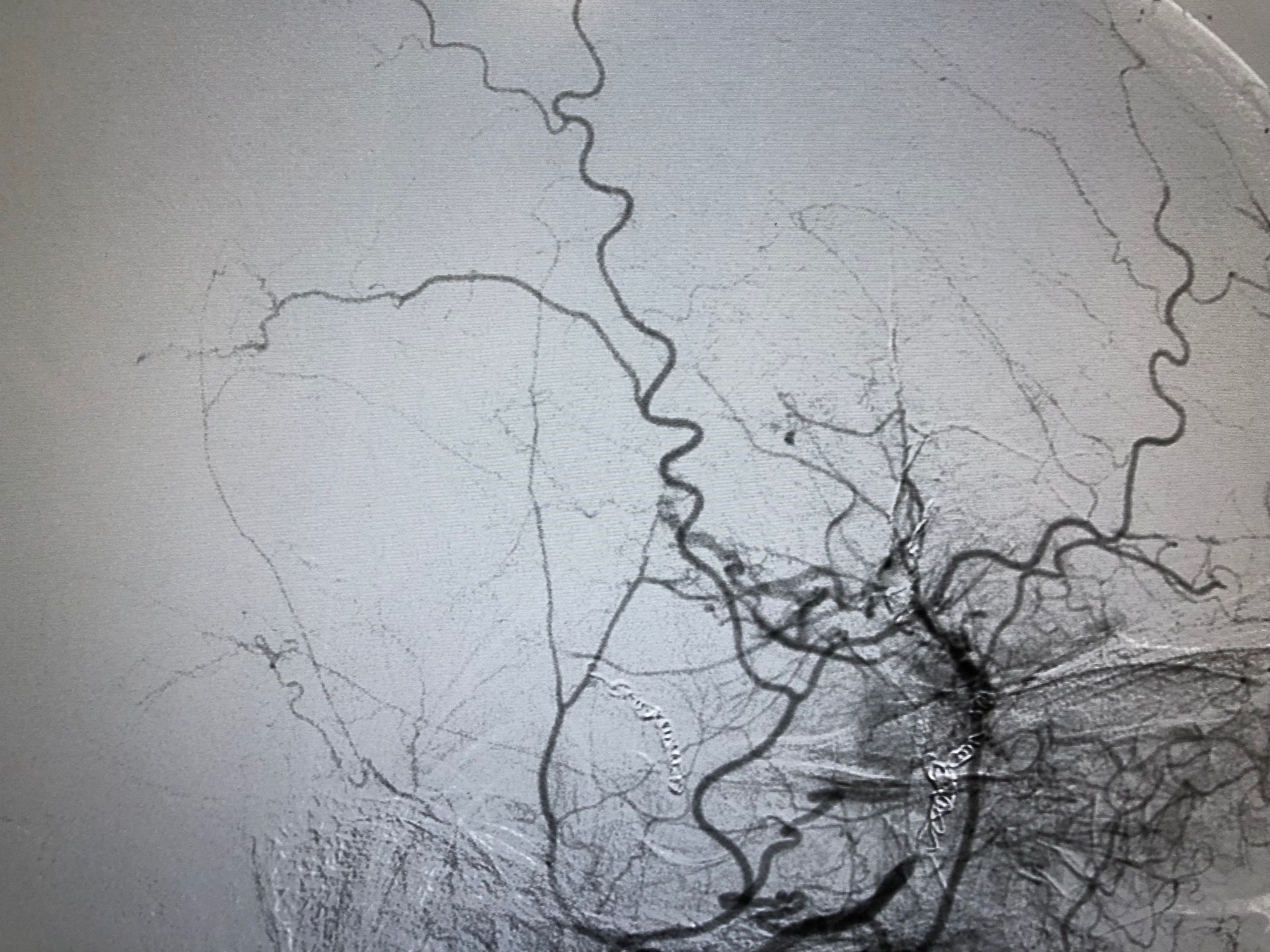 όγκος εγκεφάλου 1 προ χειρουργειου (9).jpg