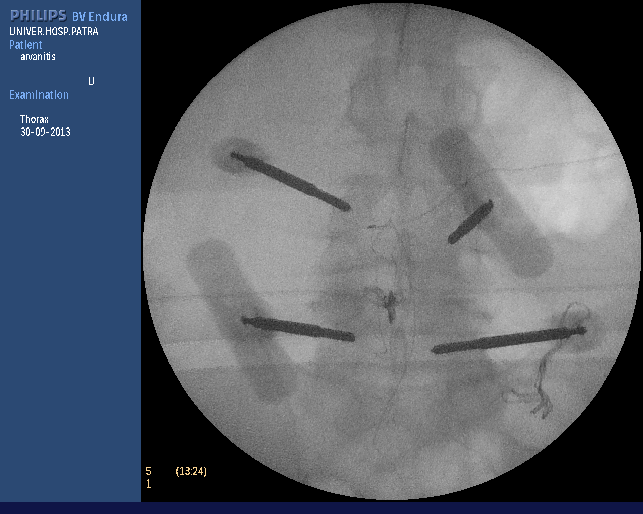 σπονδυλοδεσία (1).bmp