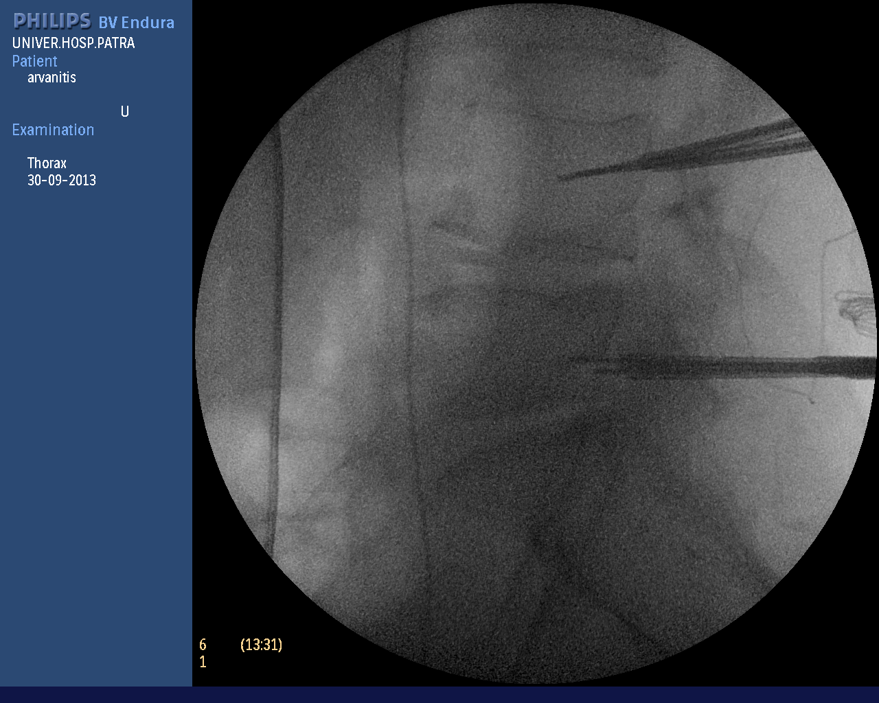 σπονδυλοδεσία (2).bmp