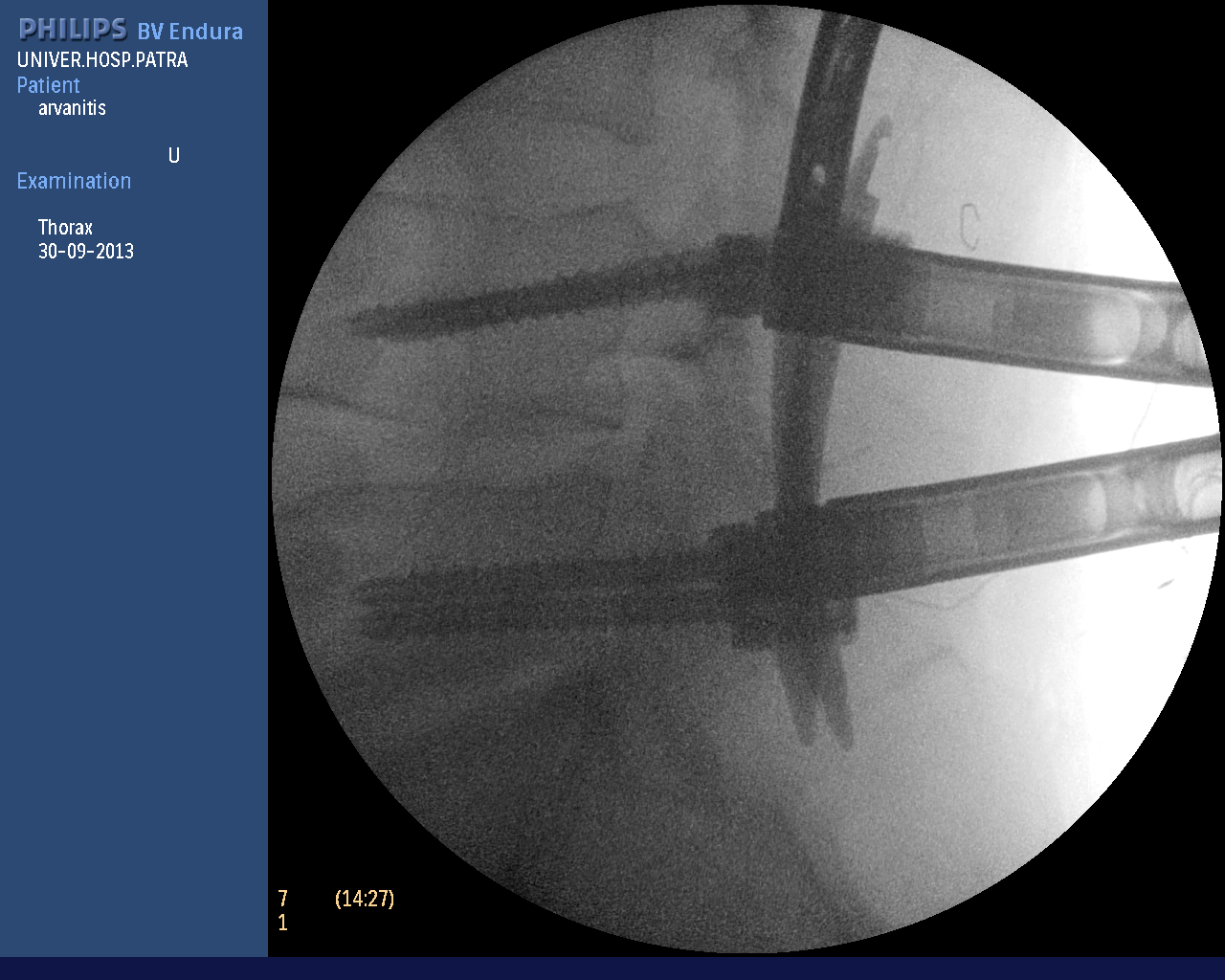 σπονδυλοδεσία (3).bmp