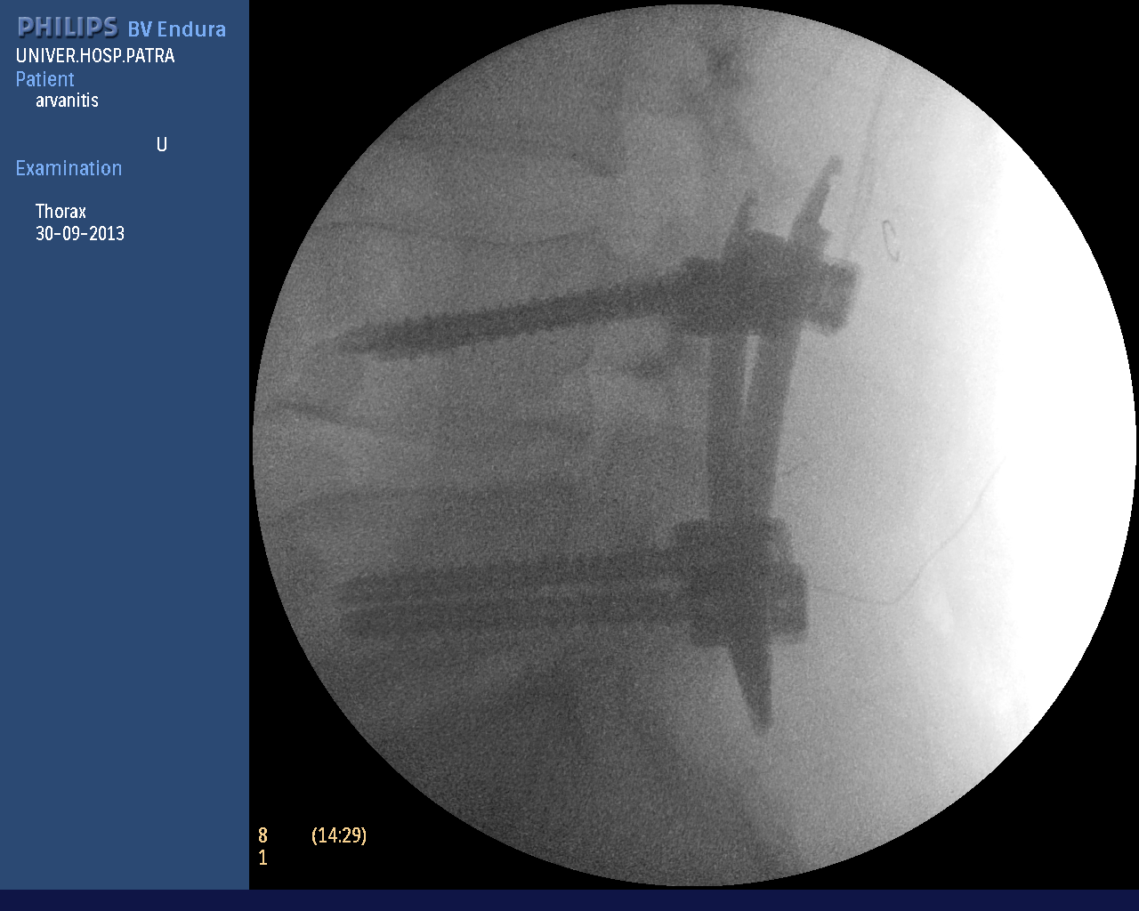 σπονδυλοδεσία (4).bmp